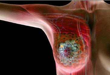 Breast Cancer Breast Cancer